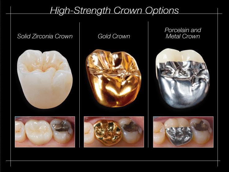 Optimal Clinical Margins And Digital Dental Scans